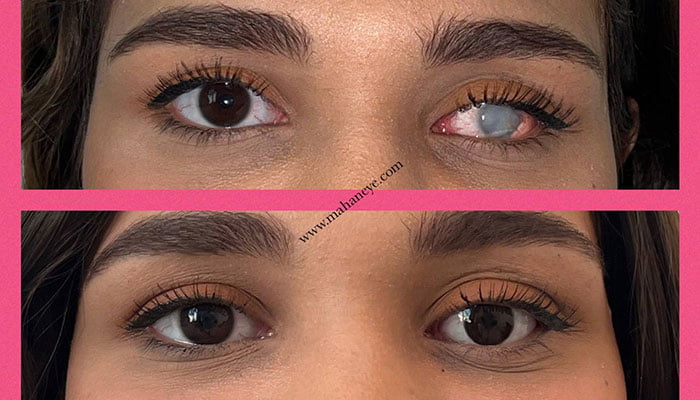 artificial eye
