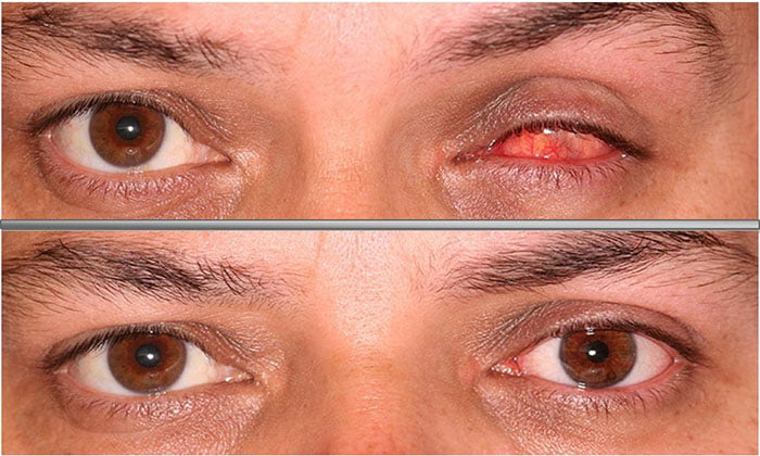 artificial eye