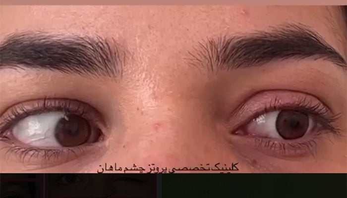 Movable eye prosthesis