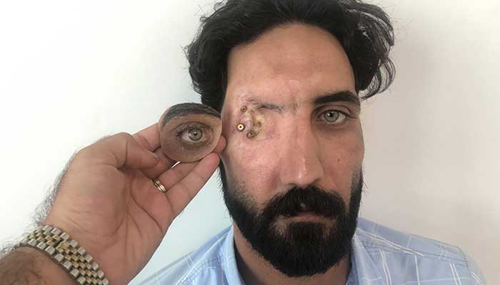 Orbital artificial eye