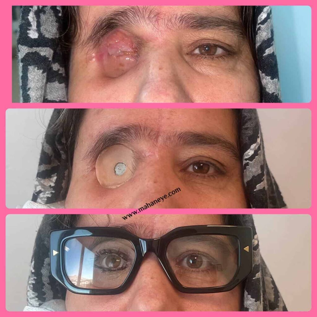 Orbital prostheses
