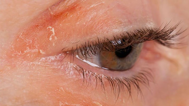 Symptoms of Blepharitis