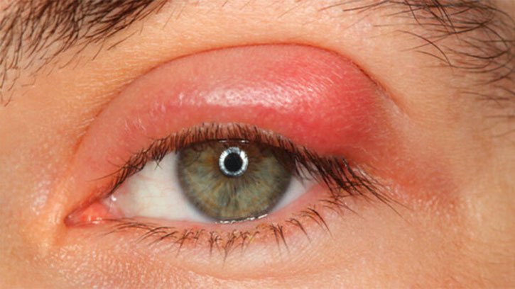 Treatment of Blepharitis