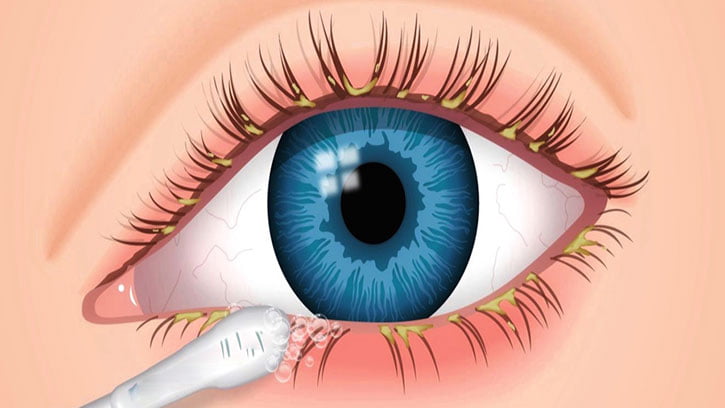 Eyelid Hygiene
