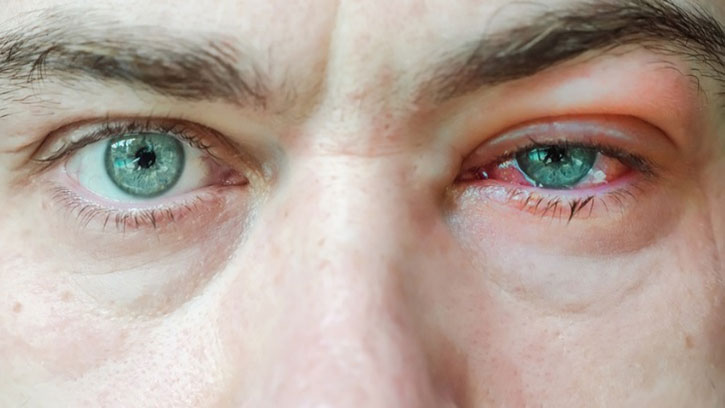 Blepharitis
