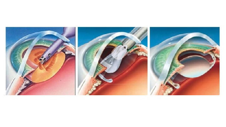 treatment of Cataracts