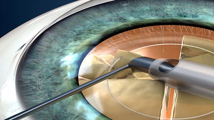 Cataract Surgery