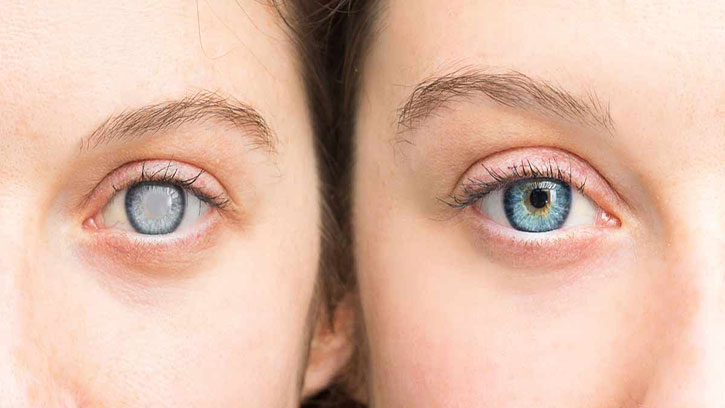 Cataracts