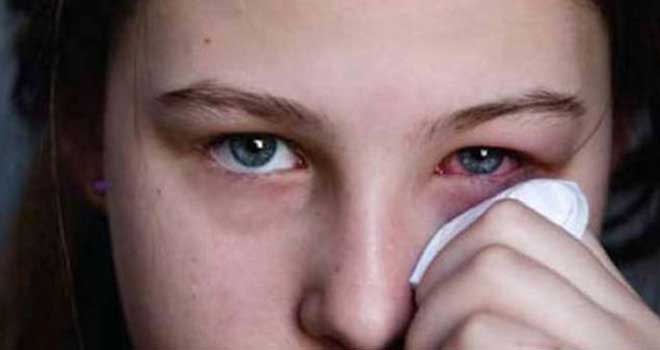 Eye Diseases