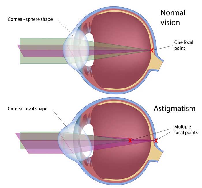 Refractive Errors