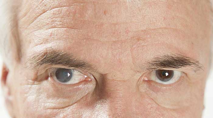 Cataracts