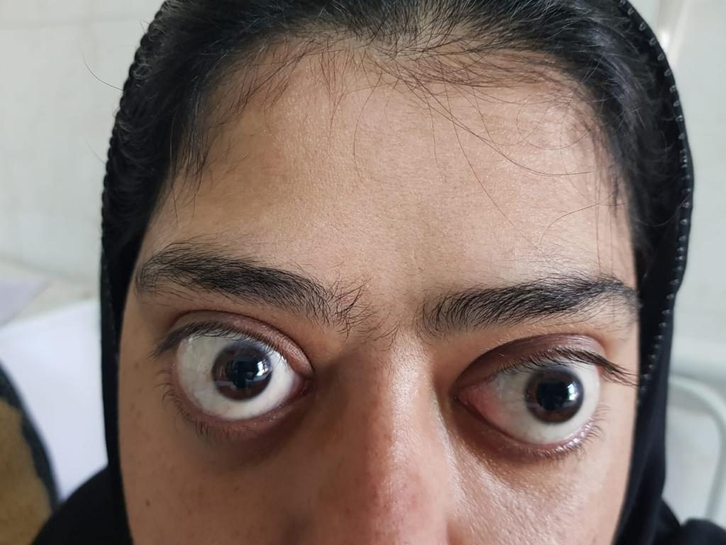 Exophthalmos (Protruding Eyes)