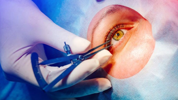 Cataract Surgery