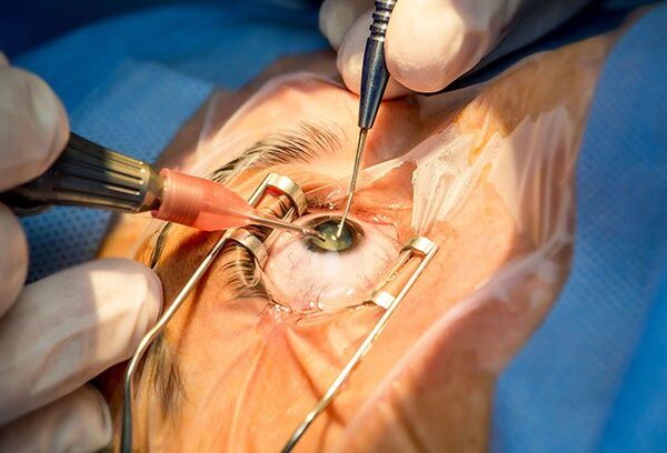 Cataract Surgery