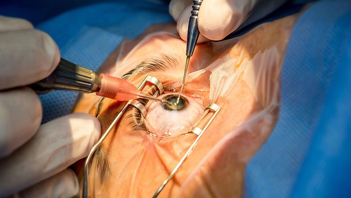 Cataract Surgery