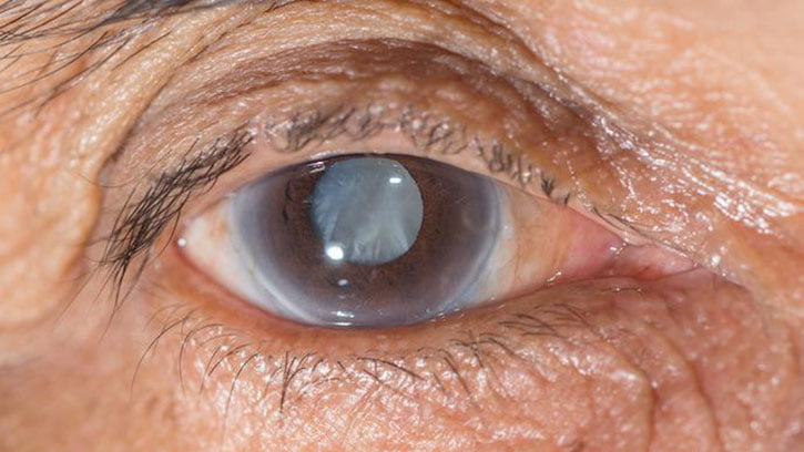 what is Glaucoma eye disease?