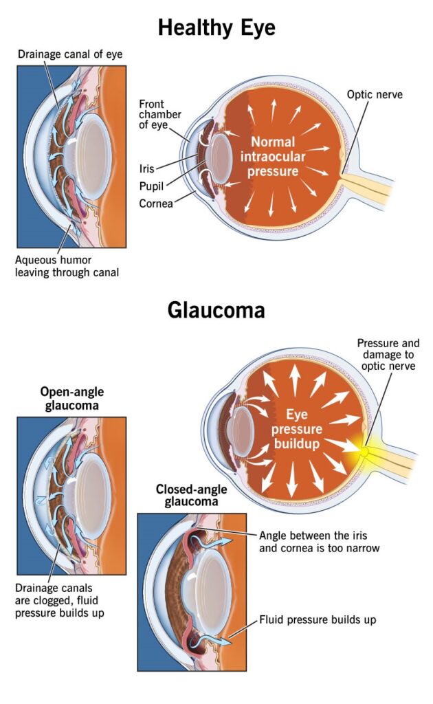 The Cause of Glaucoma