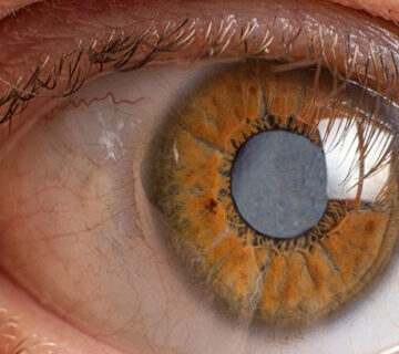 Glaucoma eye disease