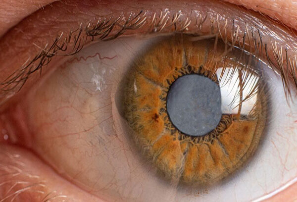 Glaucoma eye disease