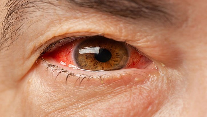 High eye pressure