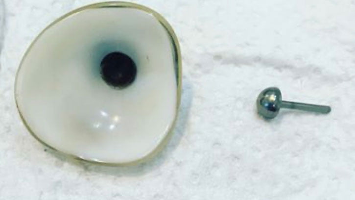 Eye implants